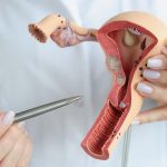 Kanker Serviks: Dapat Dicegah Melalui Vaksinasi Dan Skrining Dini